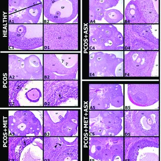 PCOS cells compared to different types of cells. 